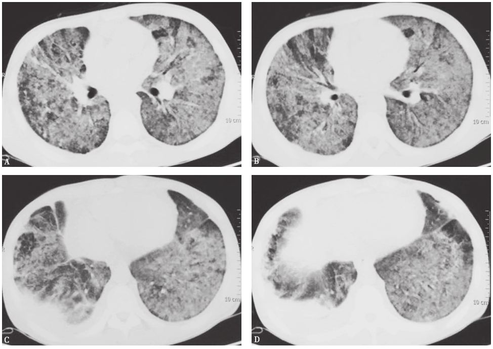 图2 胸部CT表现（2015-08-17）.jpg